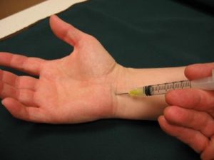 Carpal Tunnel Injection