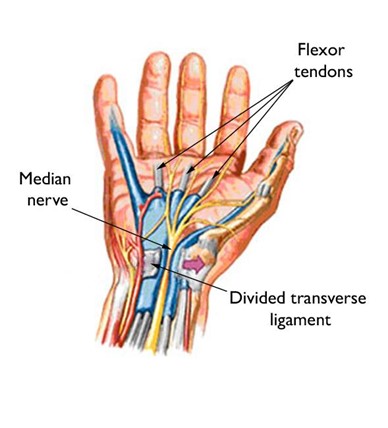 Hand Surgery for Carpal Tunnel Syndrome Pt. 2