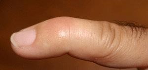 mallet finger injury