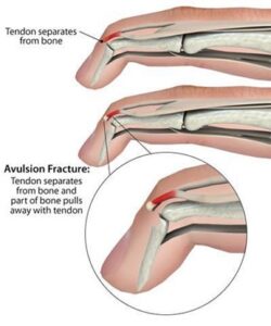 Fingertip fracture